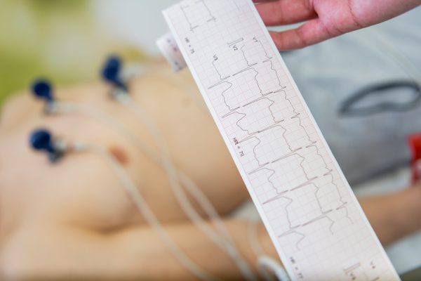 Clinical analysis in progress, precision cardiac monitoring at a A patient undergoing an electrocardiogram test with electrodes attached to the chest, as a healthcare professional examines the ECG readout.